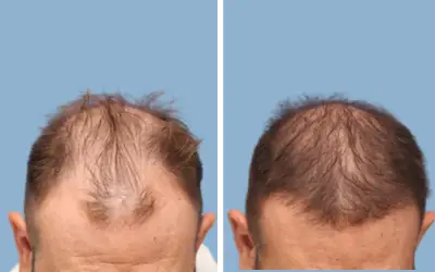 Before and After